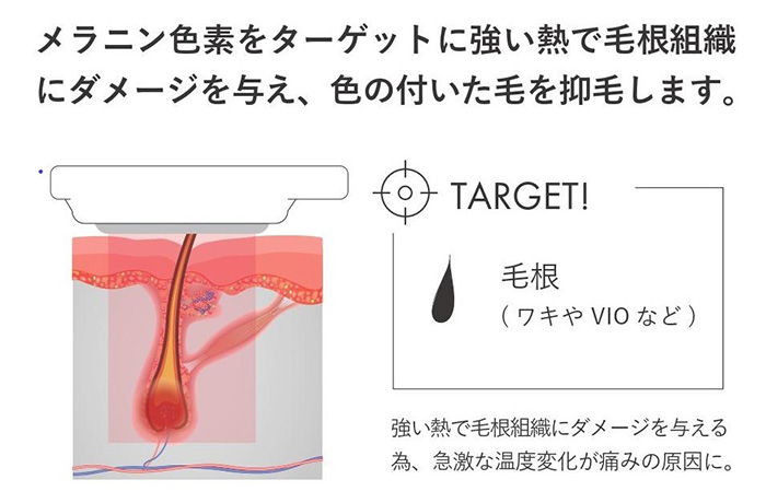 従来のIPL脱毛やレーザー脱毛